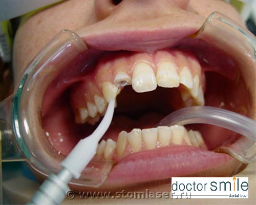 Лазерное лечение пульпита (витальная ампутация пульпы) Обработка диодным стоматологическим лазером