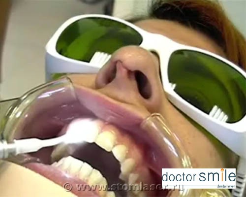 Лазерное лечение пульпита (витальная ампутация пульпы) Обработка диодным стоматологическим лазером