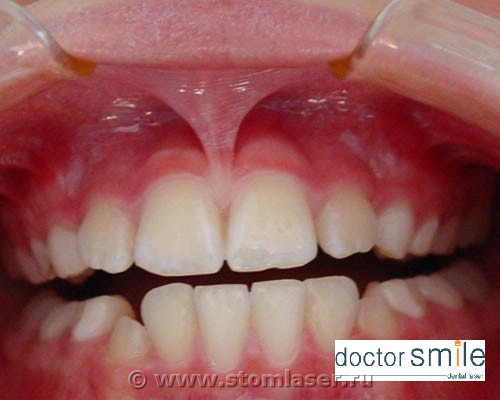 Применение диодных стоматологических лазеров в хирургической стоматологии