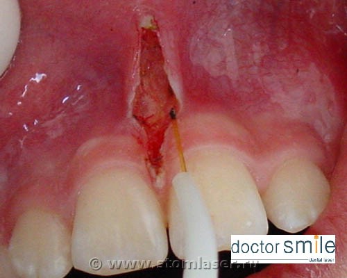 Применение диодных стоматологических лазеров в хирургической стоматологии