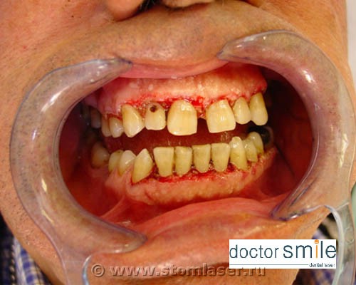 Применение диодных стоматологических лазеров в хирургической стоматологии Иссечение гипертрофированной десны
