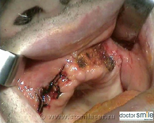 Хирургическая стоматология - применение скальпеля и лазера, сравнение. Иссечение эпулиса