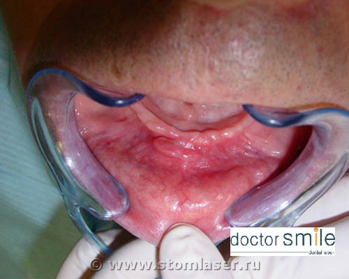 Иссечение фибромы диодным стоматологическим лазером DOCTOR SMILE™