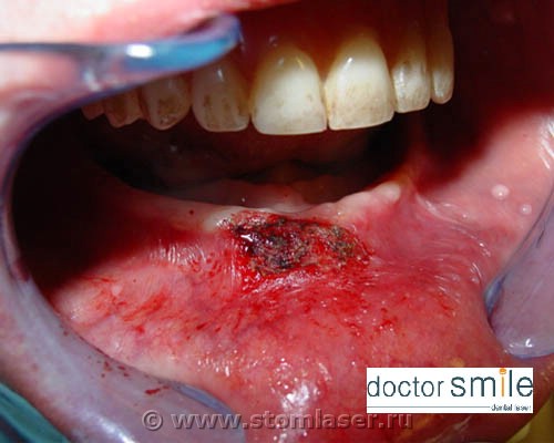 Результат. Иссечение фибромы диодным стоматологическим лазером DOCTOR SMILE™