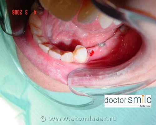 Применение диодных стоматологических лазеров в имплантологии