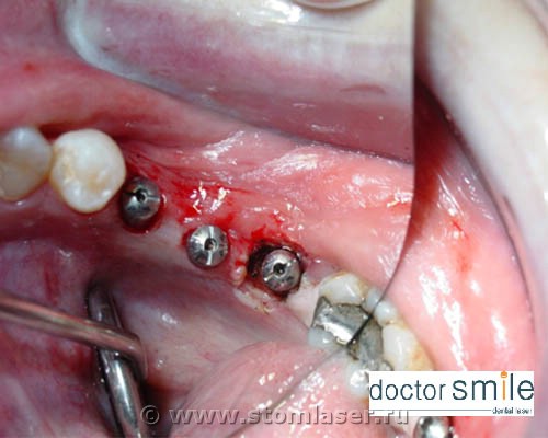 Раскрытие имплантатов с помощью диодного стоматологического лазера