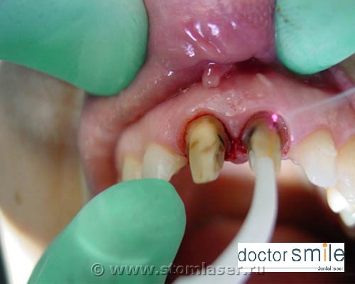 Применение диодных стоматологических лазеров в ортопедической стоматологии