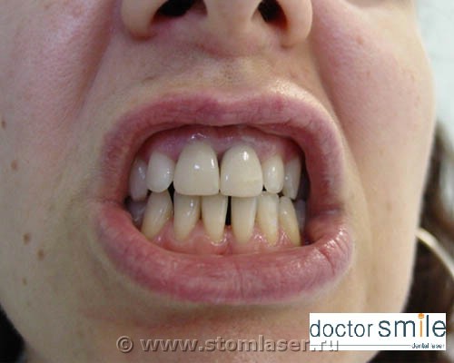 Применение диодных стоматологических лазеров в ортопедической стоматологии - протезирование