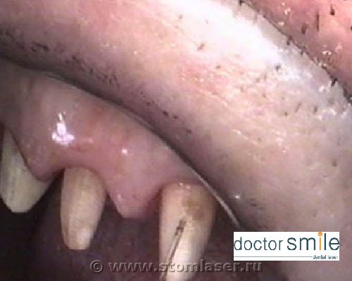 Применение диодных стоматологических лазеров в ортопедической стоматологии