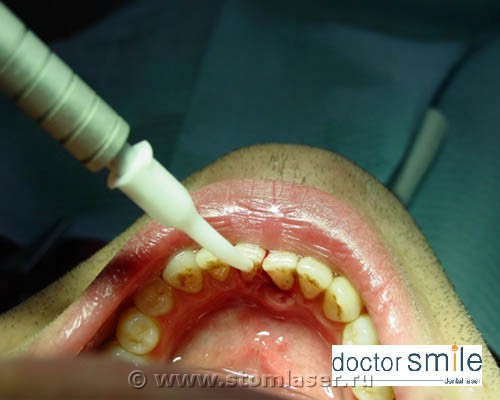 Вскрытие пародонтального абсцесса диодным стоматологическим лазером