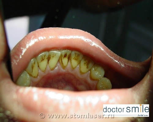 Вскрытие пародонтального абсцесса диодным стоматологическим лазером. Результат лечения.