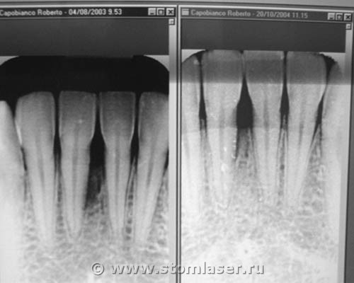 Вскрытие пародонтального абсцесса диодным стоматологическим лазером. Результат лечения, RX-контроль