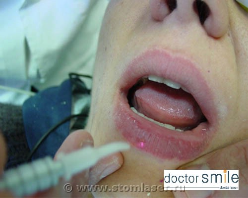 Хронический рецидивирующий герпес - применение диодных стоматологических лазеров 