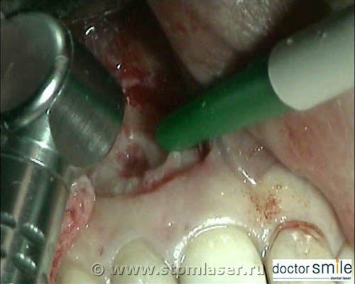 Апексэктомия Er:YAG стоматологическим лазером 
