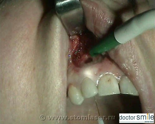 Апексэктомия Er:YAG стоматологическим лазером. Стерилизация диодным лазером 