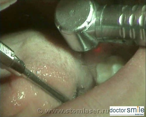 Быстрое и безболезненное лечение перикоронита с помощью стоматологического лазера