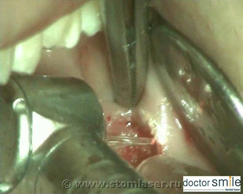Безболезненное лечение перикоронита с помощью стоматологического лазера