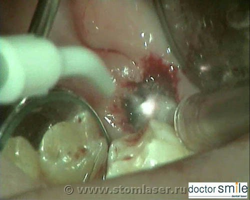 Гемостаз и стерилизация диодным стоматологическим лазером