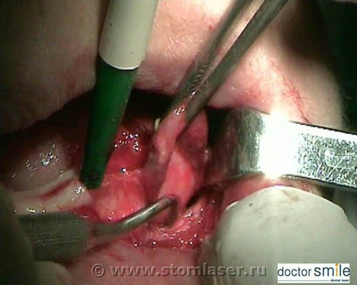Цистэктомия. Вся операция проведена с помощью Er:YAG лазера DOCTOR SMILE™
