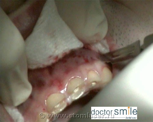 Удлинение клинической коронки стоматологическим лазером