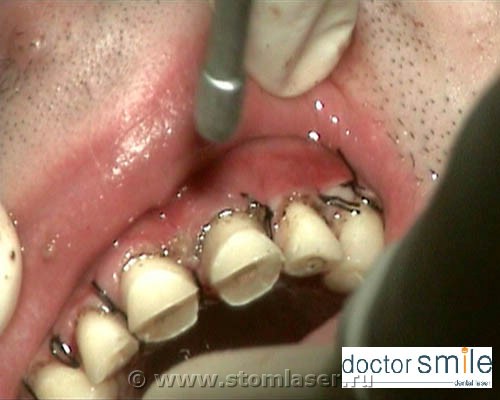 Результат лечения стоматологическим лазером