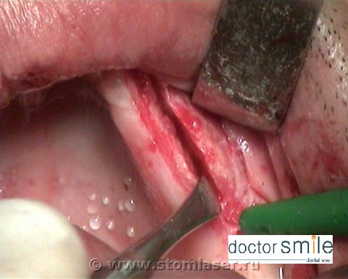 Рассечение альвеолярного отростка Er:YAG стоматологическим лазером