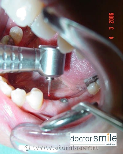 Раскрытие имплантатов Erbium YAG стоматологическим лазером