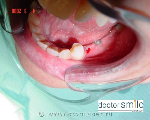 Раскрытие имплантатов Erbium YAG стоматологическим лазером