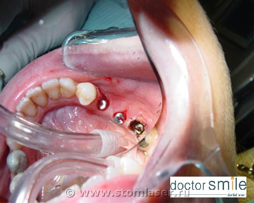 Раскрытие имплантатов Erbium YAG и диодным стоматологическим лазером