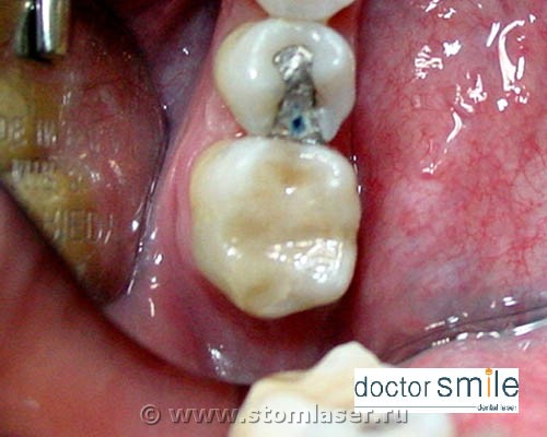 Апексэктомия Er:YAG стоматологическим лазером 
